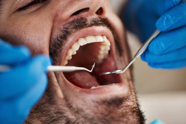 Best Emergency Tooth Extraction in Versailles, MO
